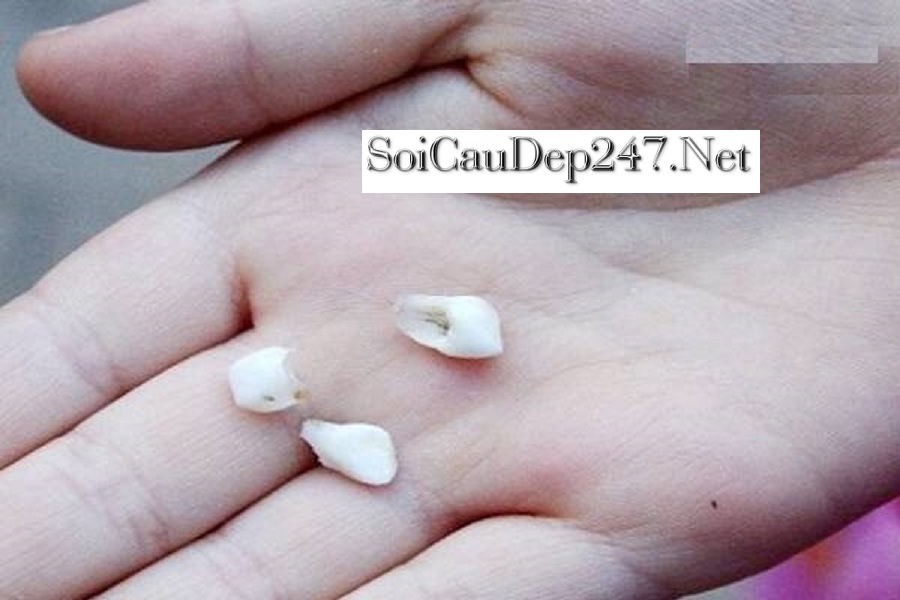 Mơ Rụng Răng Hàm Trên Đánh Con Gì?